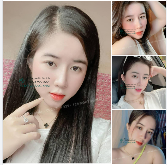 LẠI THÊM 1 CA MŨI HOÀN HẢO VỚI KĨ THUẬT NÂNG MŨI SIÊU CẤU TRÚC