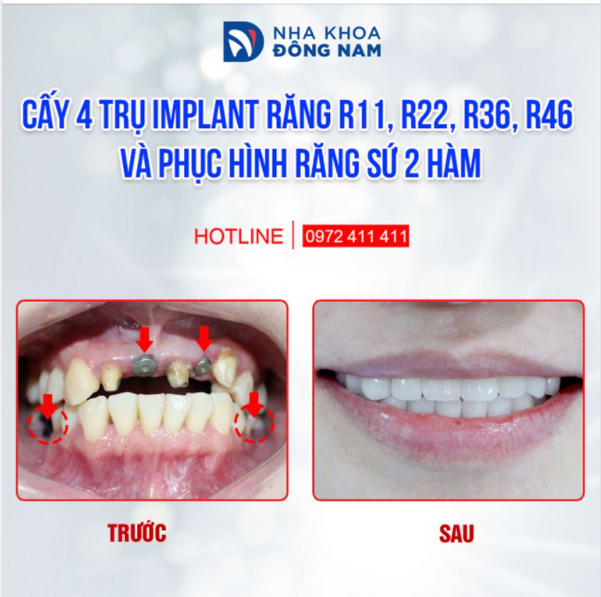 LÀM CẦU SỨ KHÔNG NGĂN ĐƯỢC TIÊU XƯƠNG, SAU 5 NĂM PHẢI CẤY IMPLANT THAY THẾ