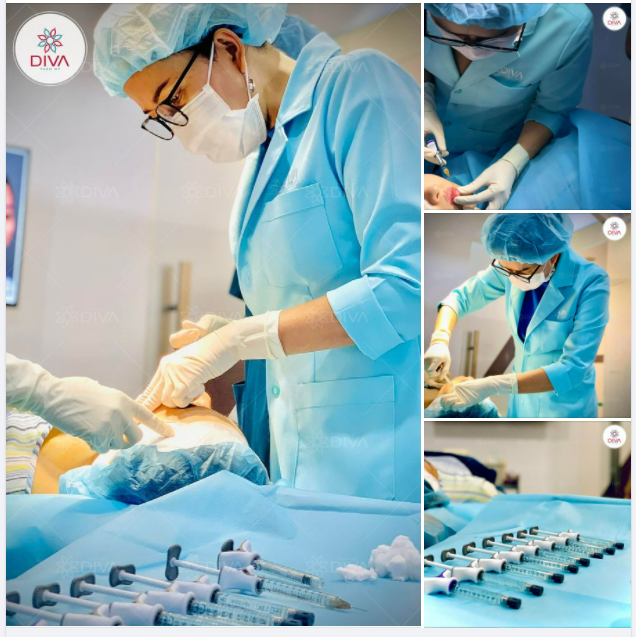 LÀM ĐẸP VỚI FILLER MD DYNAMIC CODES KHÔNG SƯNG BẦM, KHÔNG NGHỈ DƯỠNG, ĐẸP NGAY SAU THỰC HIỆN