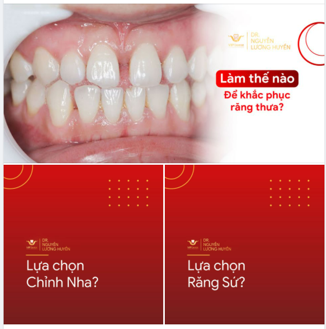 LÀM THẾ NÀO ĐỂ KHẮC PHỤC KHUYẾT ĐIỂM RĂNG THƯA