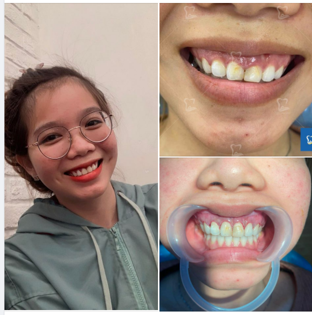 Lật vạt cắt lợi tạo khuôn cười rạng rỡ Khắc phục tình trạng cười hở lợi hiệu quả