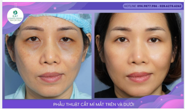 “lấy lại 10 năm tuổi xuân chỉ với combo cắt mí mắt ​​​​​​​”