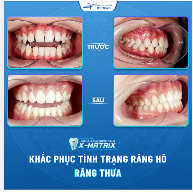 LẤY LẠI NỤ CƯỜI TỰ TIN NHỜ NIỀNG RĂNG CÔNG NGHỆ X - MATRIX