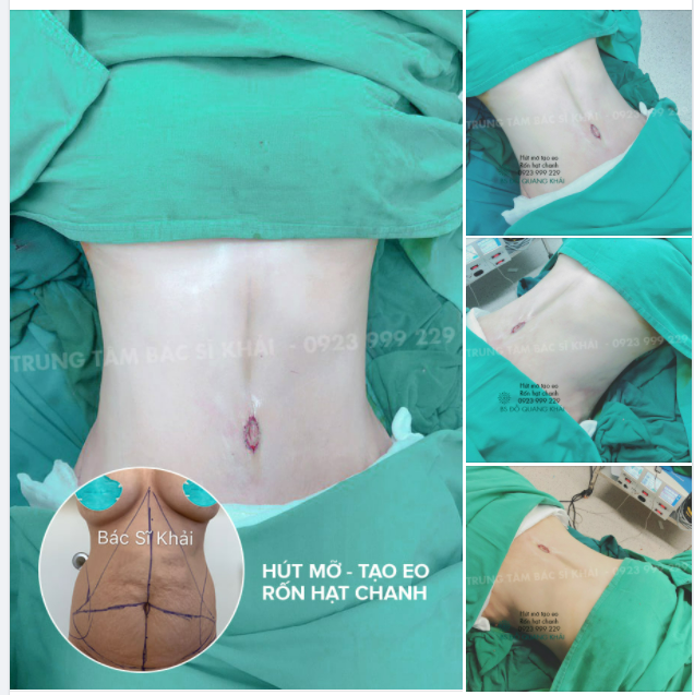 LẤY LẠI VÒNG EO CHUẨN SIZE CHỈ VỚI 60 PHÚT với bs Đỗ Quang Khải