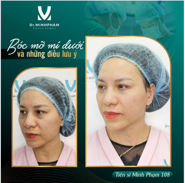 LẤY MỠ MÍ MẮT VÀ NHỮNG ĐIỀU CẦN BIẾT