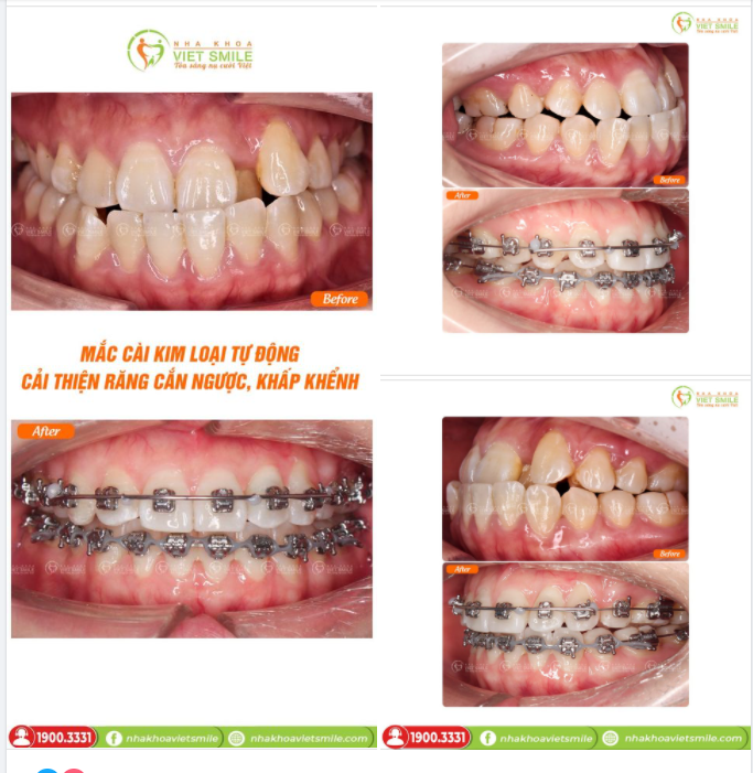 MẮC CÀI KIM LOẠI TỰ ĐỘNG CẢI THIỆN RĂNG CẮN NGƯỢC, KHẤP KHỂNH