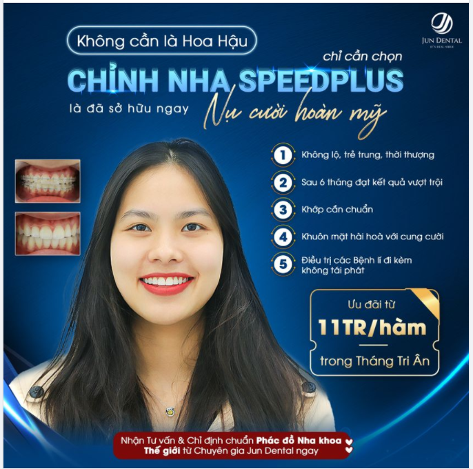 Mắc cài sứ không lộ cho trường hợp bạn Nga thay đổi ngoạn mục trong 13 tháng tại Nha khoa Thẩm mĩ Quốc tế JunDental