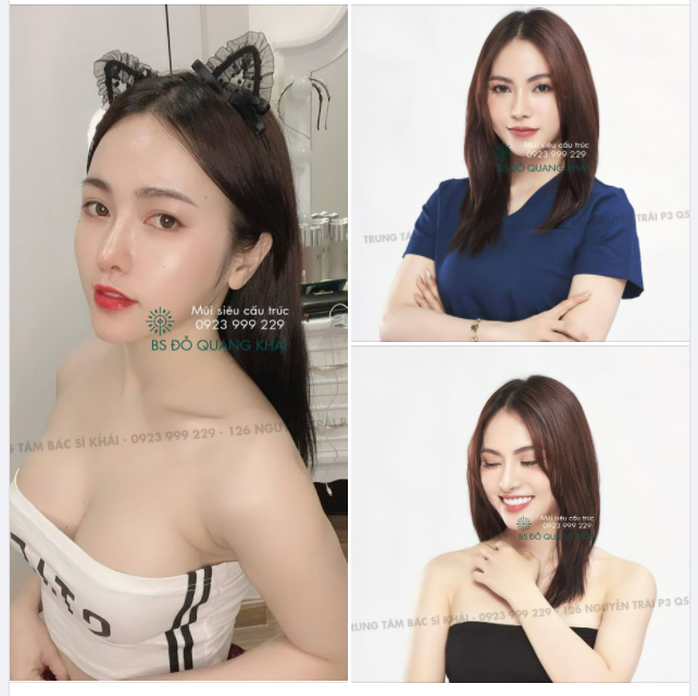 MÃN NHÃN VỚI DÁNG MŨI SIÊU CẤU TRÚC