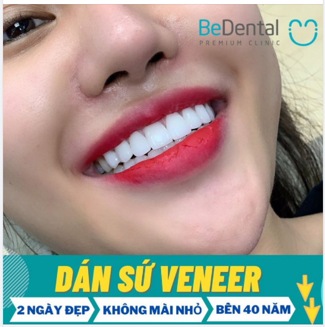 Mặt dán sứ Veneer che phủ các khuyết điểm răng ố xỉn, hô thưa, khấp khểnh, sứt mẻ