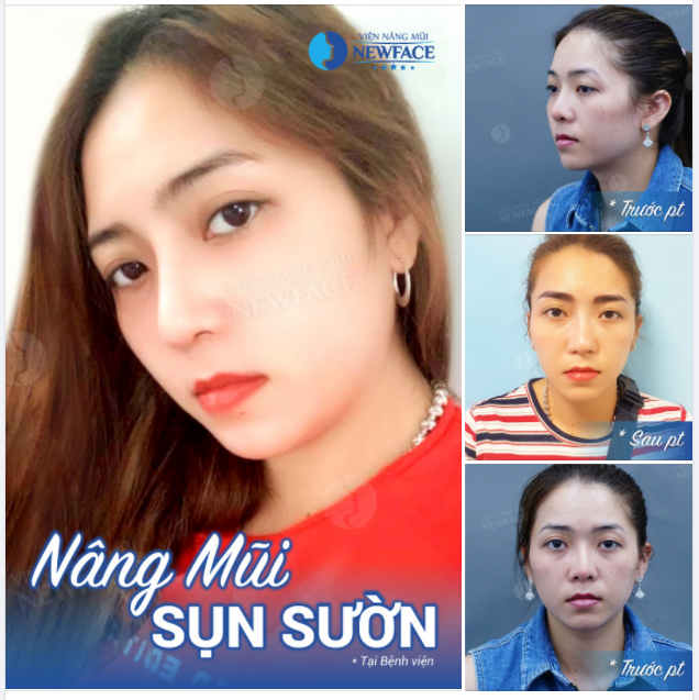 “MẶT HIỀN HƠN NHIỀU SO VỚI LẦN NÂNG MŨI TRƯỚC”