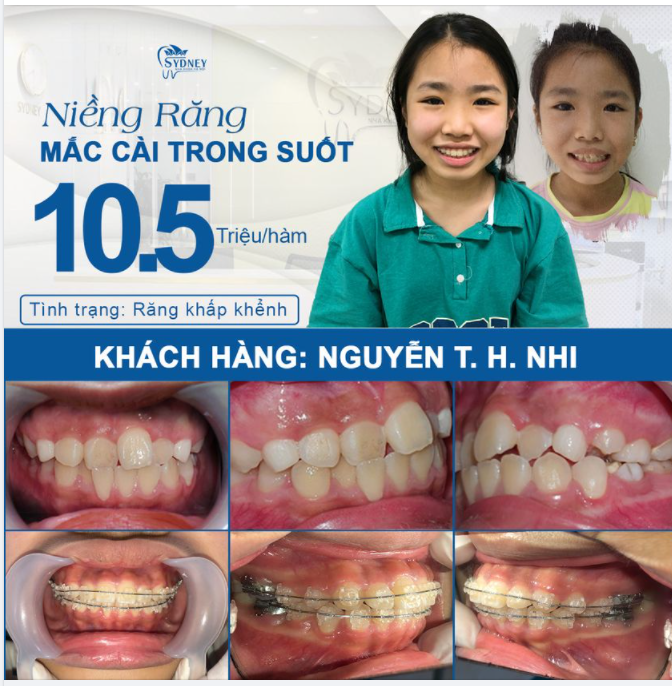 MẶT LỆCH RĂNG KHẤP KHỂNH - KHẮC PHỤC HIỆU QUẢ CÙNG MẮC CÀI TRONG SUỐT