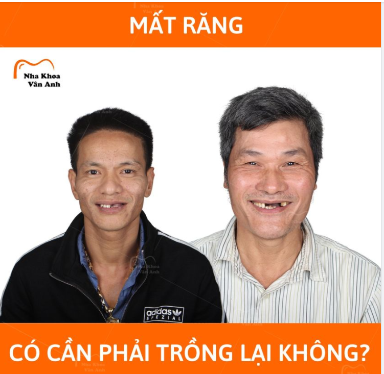 Mất răng có thể do nhiều nguyên nhân như sâu răng, viêm tủy, viêm nha chu hoặc một số chấn thương khác….