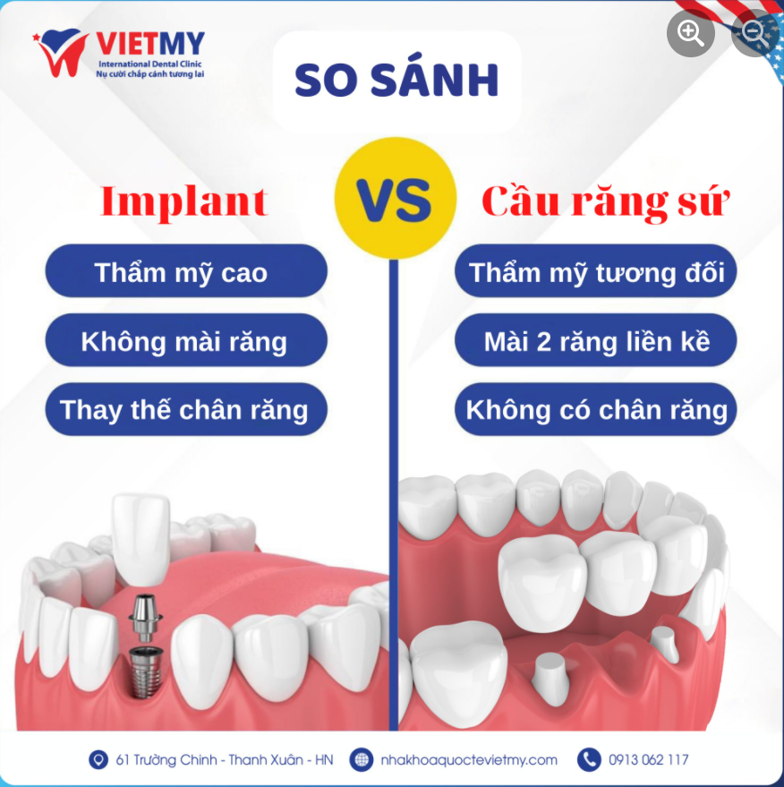 MẤT RĂNG - LỰA CHỌN TRỒNG RĂNG IMPLANT HAY CẦU RĂNG SỨ