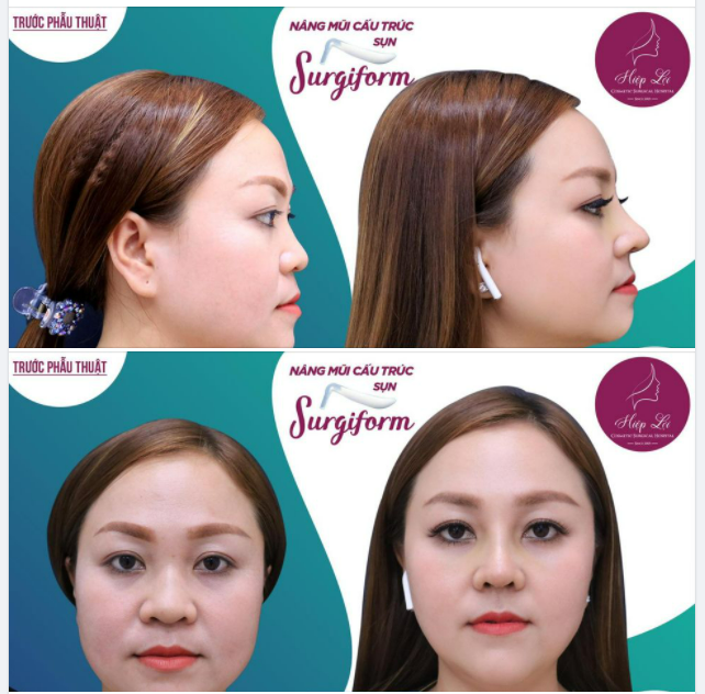 Mặt tròn trịa đầy đặn thì nên làm MŨI gì cho đẹp