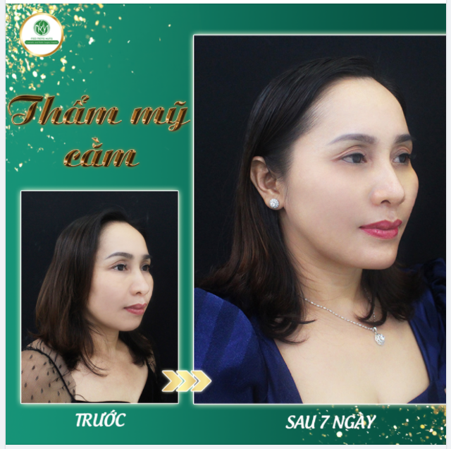 MẶT V LINE HÀI HÒA CÂN ĐỐI SAU ĐỘN CẰM