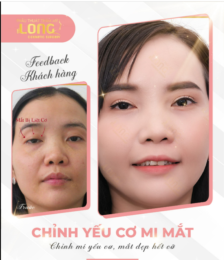 MẮT YẾU CƠ, CẦN PHÁT HIỆN VÀ ĐIỀU TRỊ KỊP THỜI.