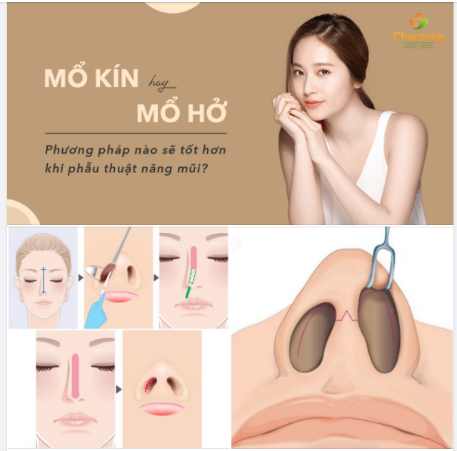 MỔ HỞ HAY MỔ KÍN CÁCH NÀO SẼ TỐT HƠN KHI NÂNG MŨI