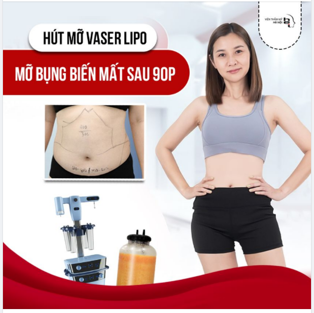MỠ TÍCH TỤ BAO NHIÊU NĂM CŨNG “BIỆT TÍCH” SAU 60 PHÚT Nhờ công nghệ hút mỡ VASER LIPO
