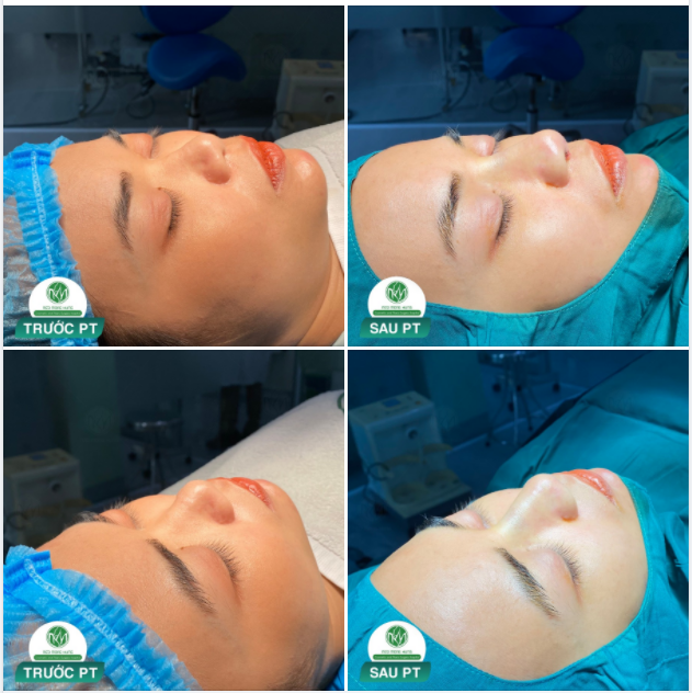 MỜI CẢ NHÀ CHIÊM NGƯỠNG DÁNG MŨI MỚI NHẤT TẠI BỆNH VIỆN
