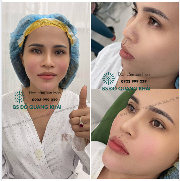 Mới độn cằm xong mà nhìn kết quả mình ưng mắt hết ý