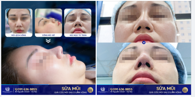Mỗi lần soi gương nhìn cái mũi lệch mà stress