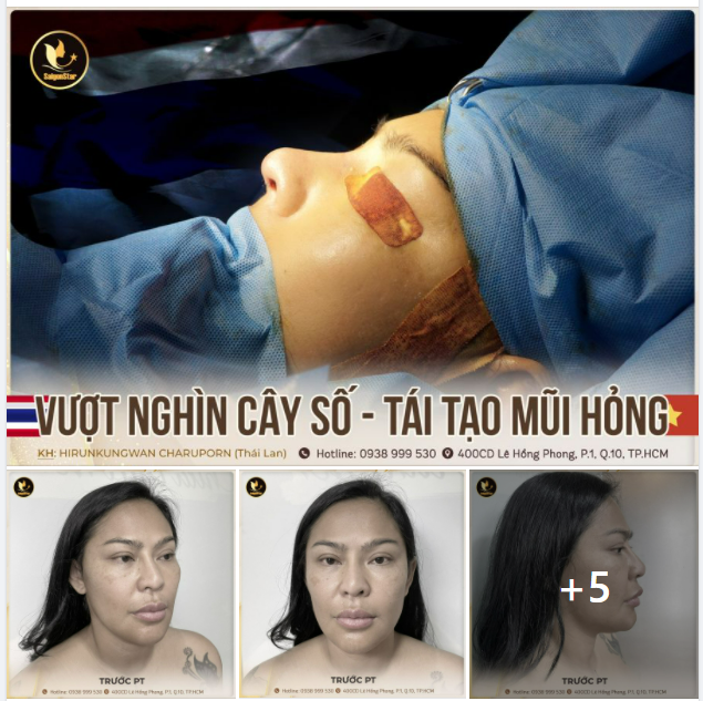 MONG TÌM KIẾM VẺ ĐẸP HOÀN HẢO, NGƯỜI PHỤ NỮ THÁI LAN VƯỢT HÀNG NGHÌN CÂY SỐ GẶP BÁC SĨ HOẠT