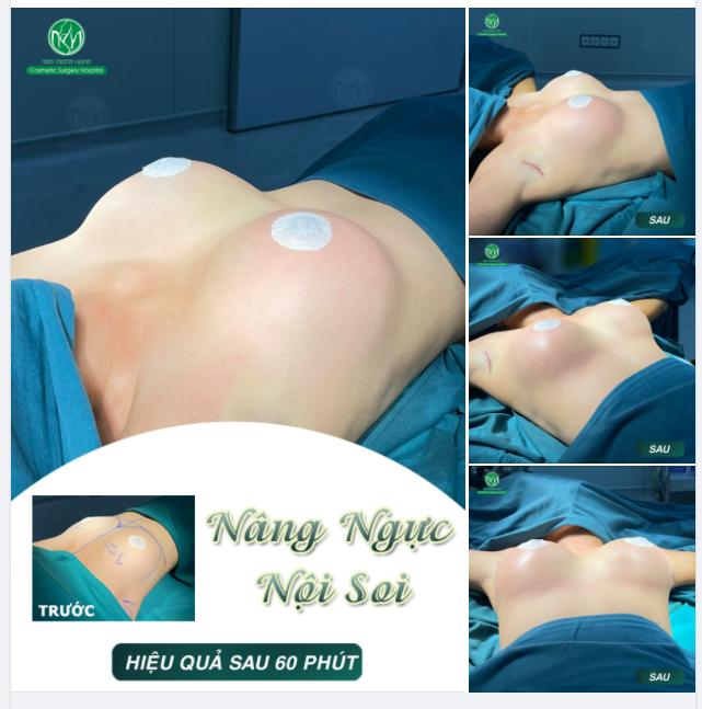 MỘT CA NÂNG NGỰC ĐẶT TÚI MENTOR CHO KH 25 TUỔI