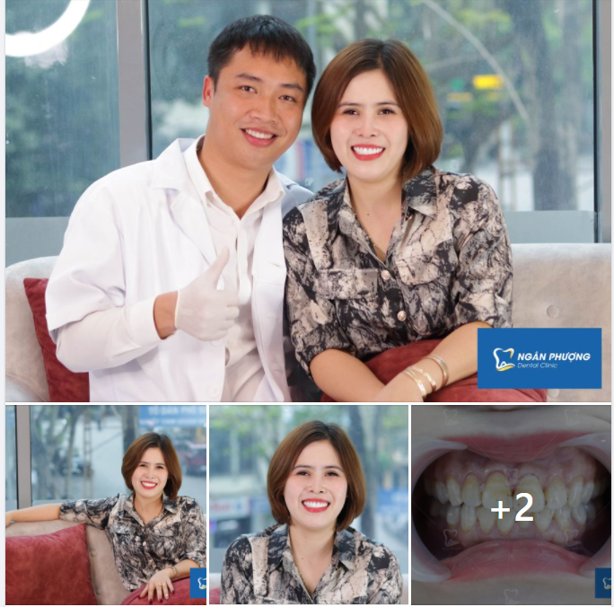 Một lần làm sứ, một lời nói không với răng xấu, xỉn màu 