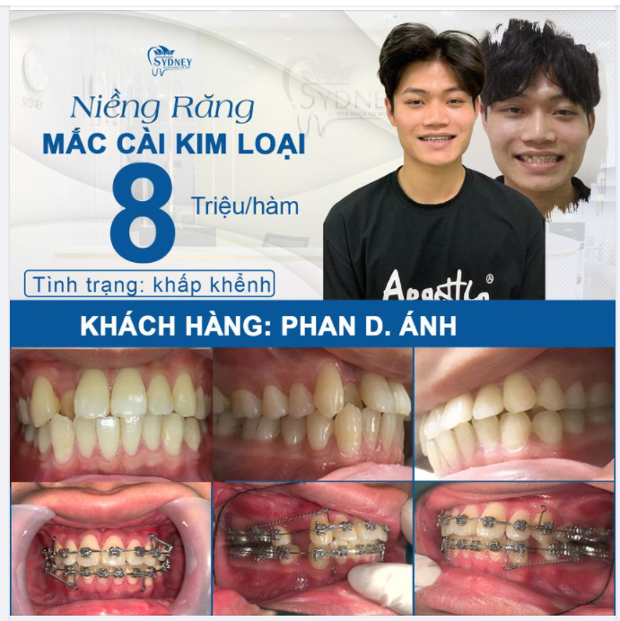 MỘT SỐ BÍ QUYẾT VỆ SINH NIỀNG RĂNG HỮU ÍCH KHÔNG NÊN BỎ QUA 