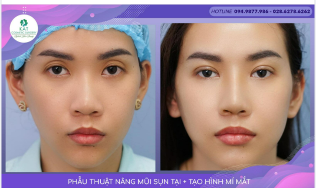 Một sự thay đổi kì diệu với 15 phút. Bạn có tin đây là cùng một đôi mắt