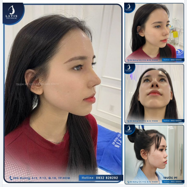 Mũi cấu trúc 10 ngày cho TEAM mê dáng tự nhiên