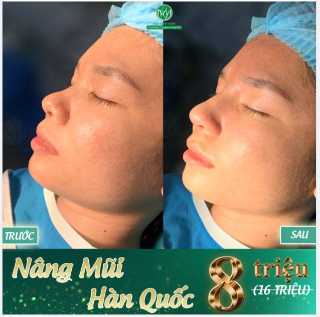 MŨI ĐẸP ĐÓN ĐẠI LỄ LỚN NHẤT NĂM