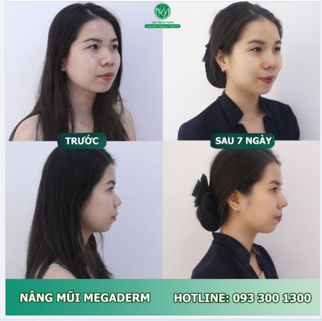 MŨI ĐẸP, SANG - TỰ TIN ĐÓN LỄ
