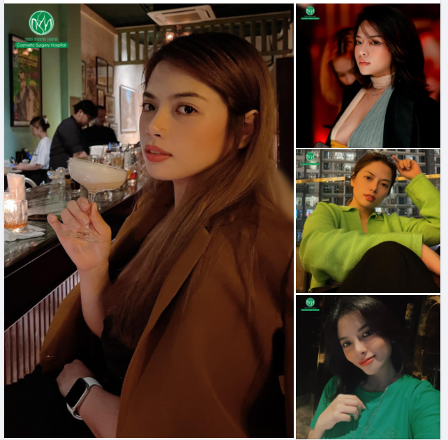 MŨI ĐẸP SAU 5 NĂM NÂNG MŨI
