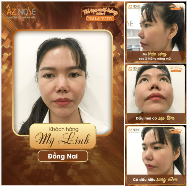 Mũi gặp vấn đề chỉ sau 2 tháng vì đặt niềm tin sai chỗ...