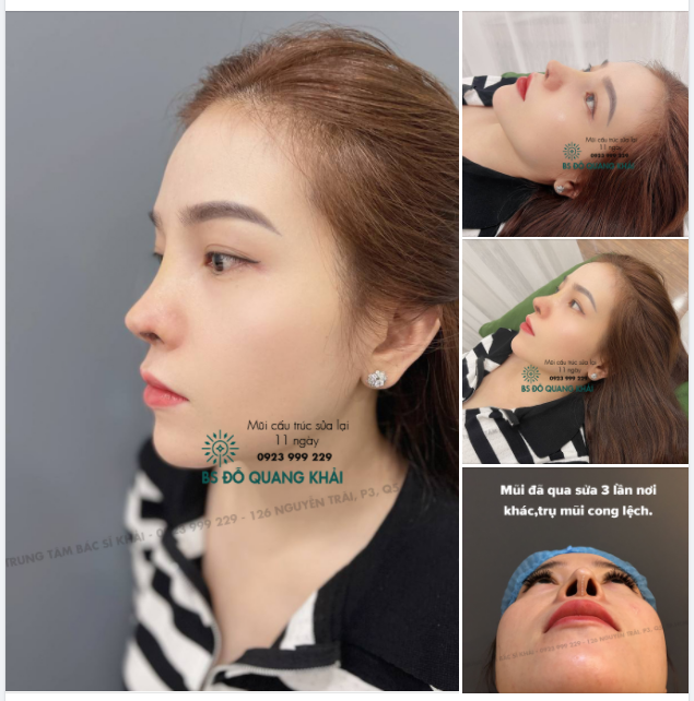 MŨI HƯ 3 LẦN, ĐI NHIỀU NƠI TỪ CHỐI ĐẾN BS KHẢI BẠN GÁI KHÓ TIN KHI NHẬN LẠI KẾT QUẢ