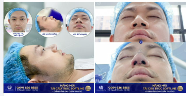 MŨI LỆCH VẸO, BIẾN DẠNG DO TAI NẠN THÌ KHẮC PHỤC THẾ NÀO