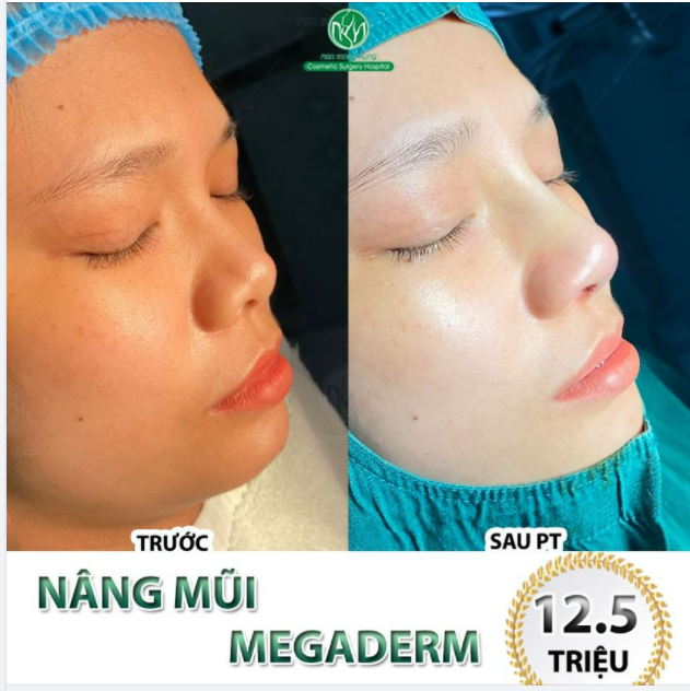 MŨI MEGADERM TRỌN GÓI CHỈ 12.5 TRIỆU