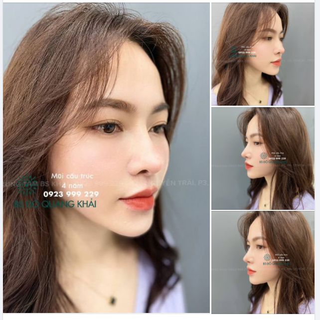 MŨI NHÀ BÁC SĨ KHẢI ĐƯỢC 4 NĂM NHA CÁC BẠN