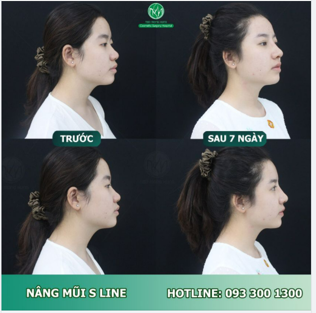 MŨI NHIỀU KHUYẾT ĐIỂM - THAM KHẢO NGAY DÁNG MŨI S LINE