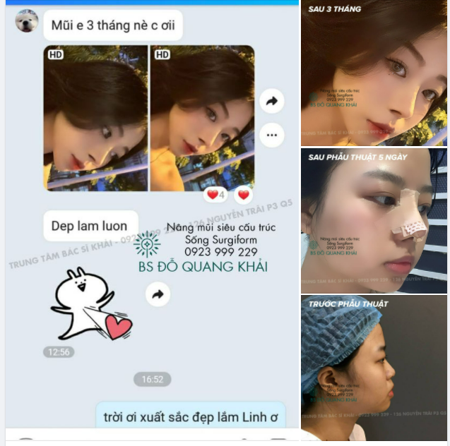 MŨI SIÊU PHẨM SAU 3 THÁNG PHẪU THUẬT