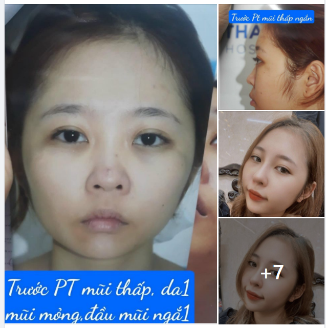 MŨI THANH THOÁT LỘC PHÁT ĐẦY NHÀ! NÂNG MŨI AN TOÀN - DÁNG ĐẸP NHƯ Ý -