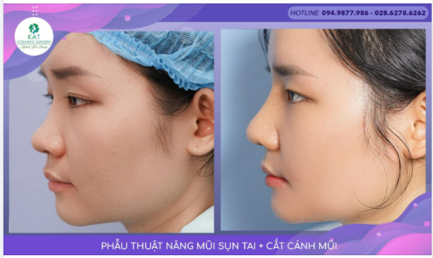 Mũi thấp khiến bạn không hài lòng không tự tin khi chụp ảnh hay phải đánh khối quá nhiều khi trang điểm ​​​​​​​.