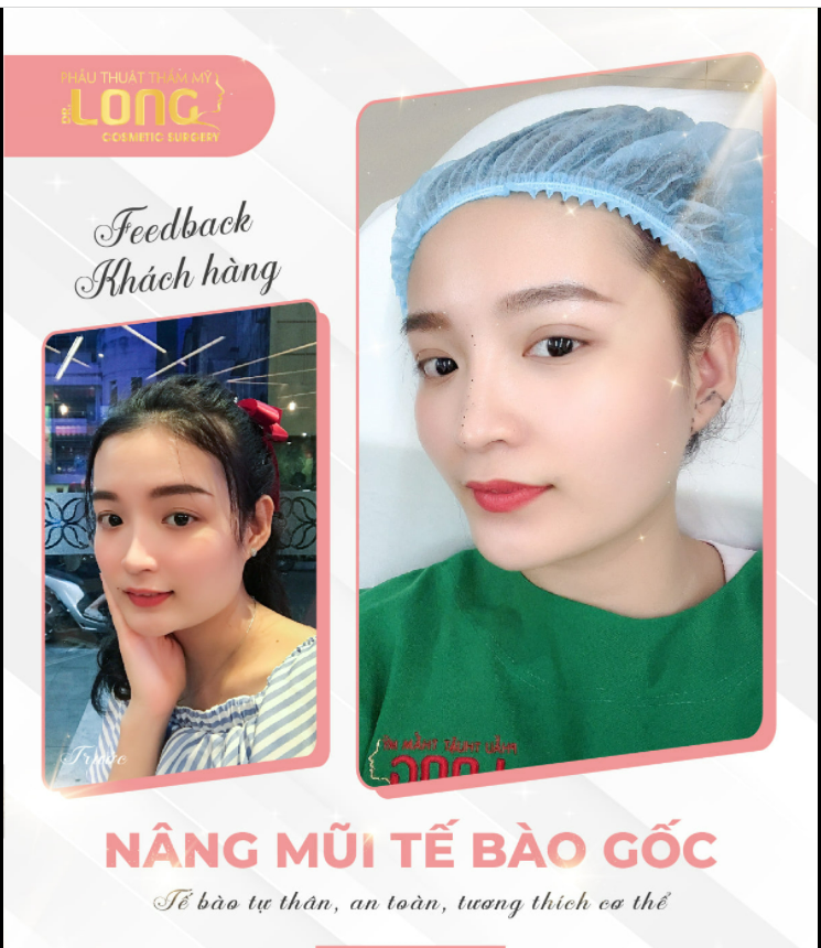 Muốn có dáng mũi đẹp nhưng lại không muốn để ai biết mình đã từng can thiệp phẫu thuật