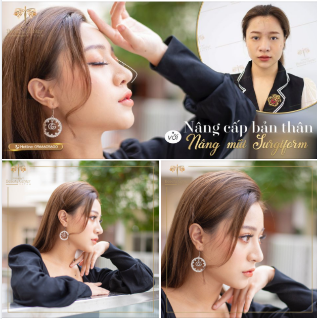 Nâng cấp bản thân với nâng mũi Surgiform