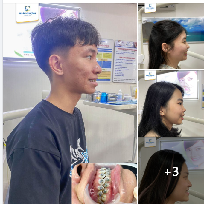 Nắng mưa là việc của trời Niềng răng là việc của nha khoa hay làm