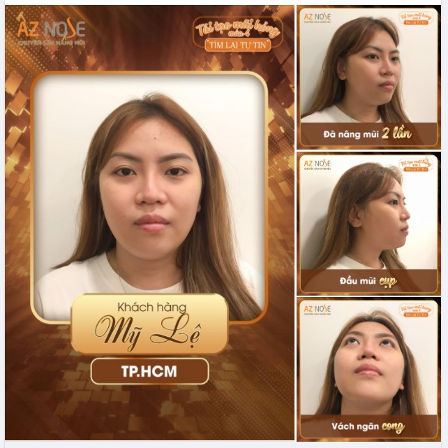 Nâng mũi 2 lần vẫn không ưng ý vì đặt niềm tin sai chỗ...