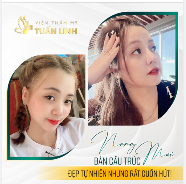 NÂNG MŨI BÁN CẤU TRÚC - ĐẸP NHẸ NHÀNG LÊN DÁNG CHUẨN TỰ NHIÊN.