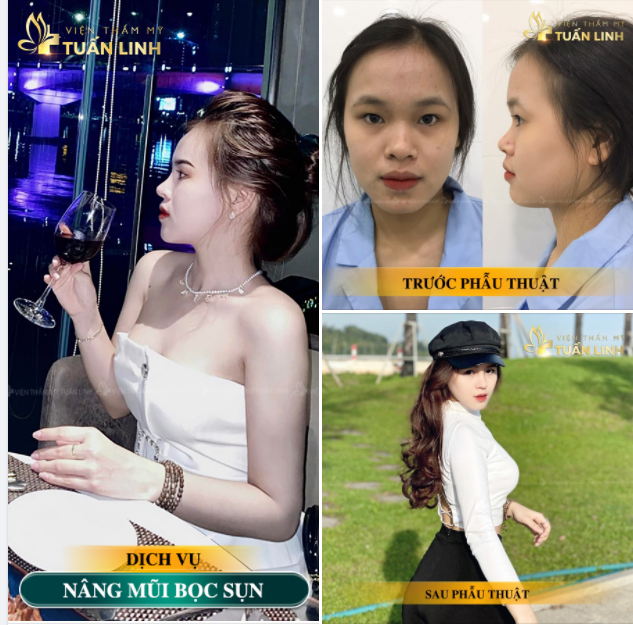 Nâng mũi bọc sụn giá chỉ 12tr - trả góp lãi suất 0%