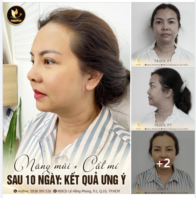 NÂNG MŨI + CẮT MÍ SAU 10 NGÀY ƯNG Ý KẾT QUẢ